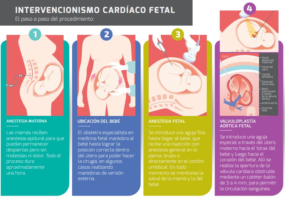 El paso a paso de la intervención cardíaca fetal (gentileza Hospital Italiano)